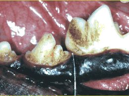 De zwarte aanslag is tandplaque en kan met poetsen worden verwijderd.